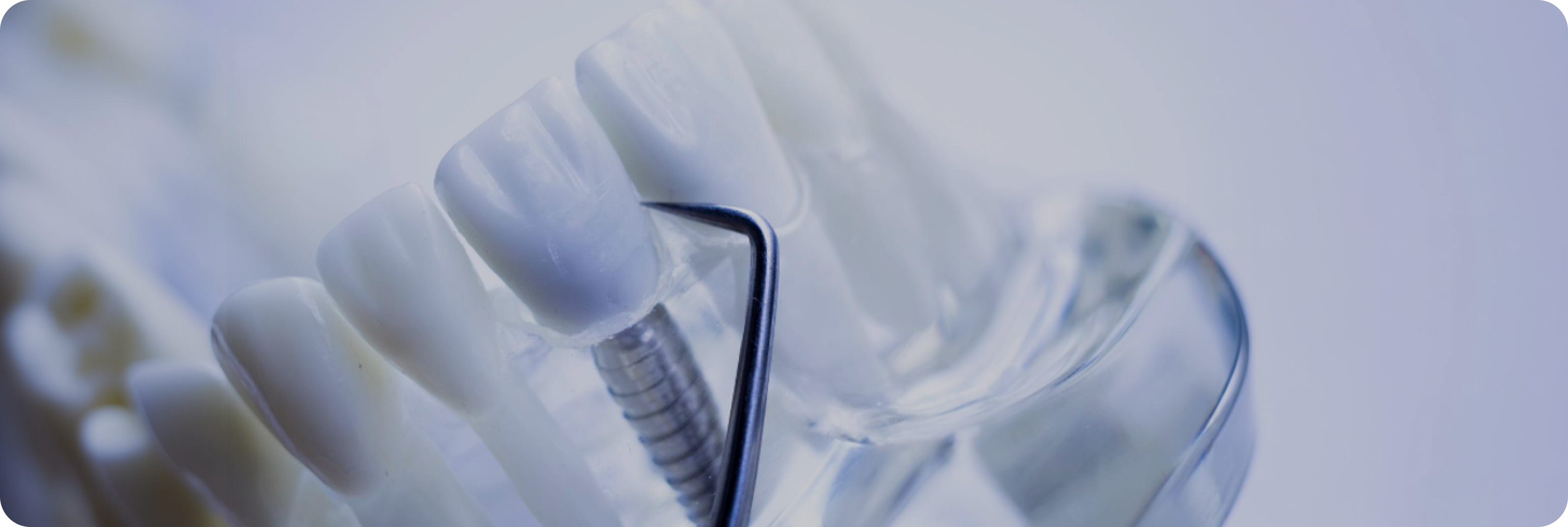 한 번의 임플란트, 평생의 약속